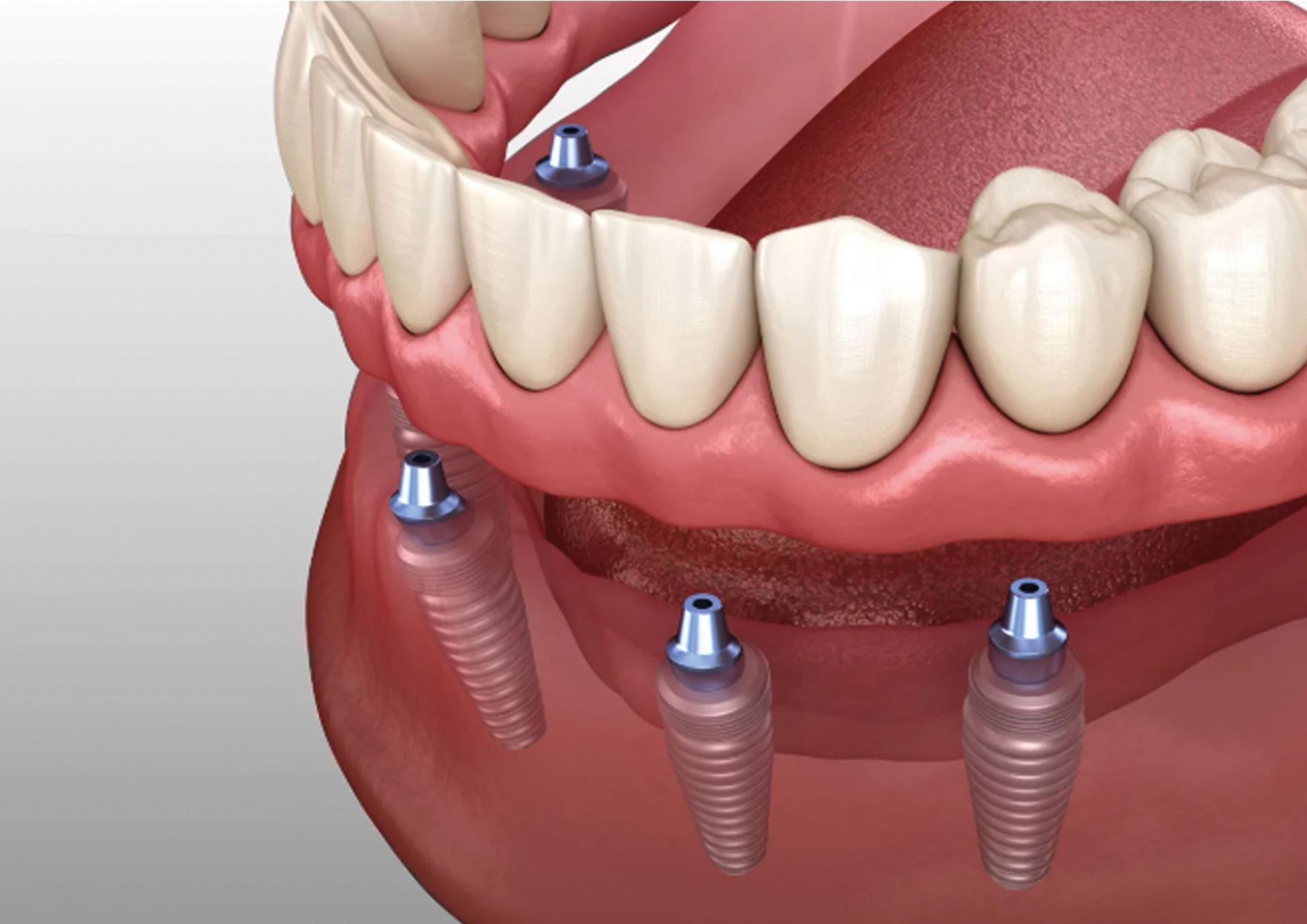 Implant Supported Dentures 