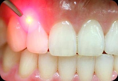 Laser Gingivectomy